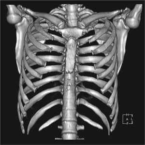 16列CTでの肋骨3D