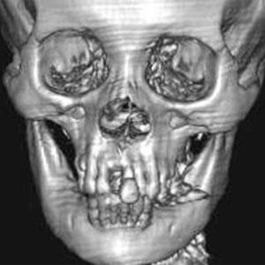 4列CTでの頭部3D