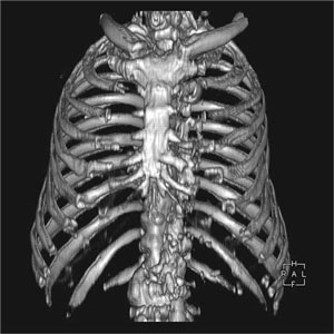 4列CTでの肋骨3D