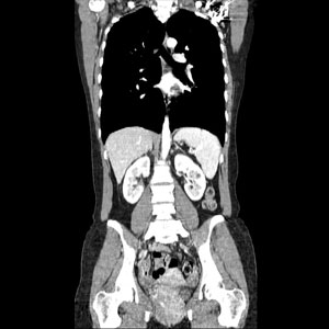 4列CTでの胸腹部冠状断像