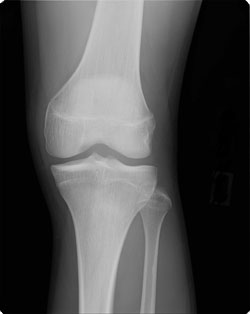 正常な膝関節（正面）