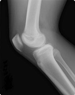 正常な膝関節（側面）