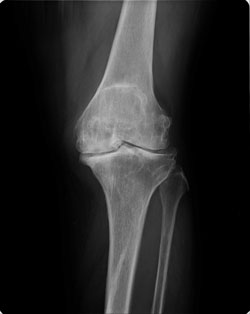 末期変形性膝関節症の膝（正面）