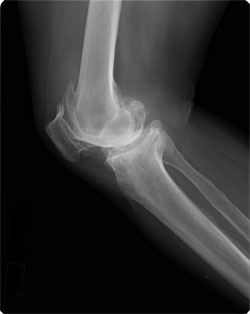 末期変形性膝関節症の膝（側面）