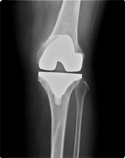 人工膝関節全置換術後の膝（正面）