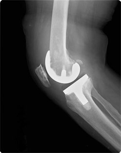人工膝関節全置換術後の膝（側面）